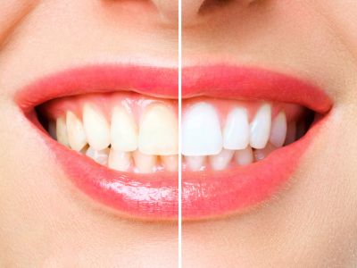 Teeth Whitening In North York